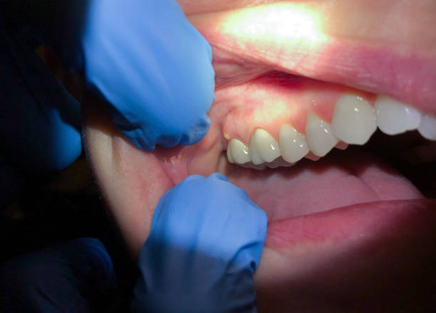 Best Emergency Denture Repair in Fremont, MI