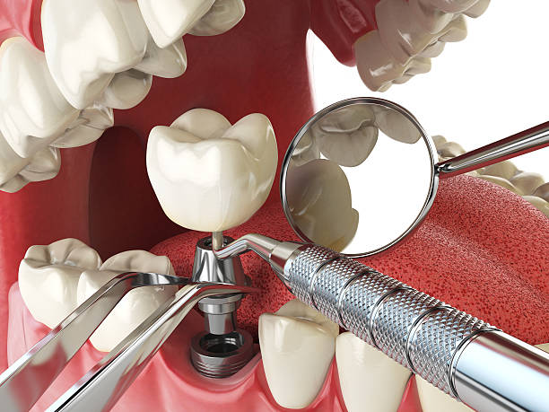 Best Emergency Wisdom Tooth Extraction in Fremont, MI